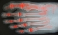 Beneficial Stretches for Arthritic Feet and Ankles