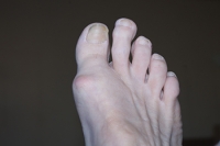 Morton’s Toe and and Morton’s Neuroma